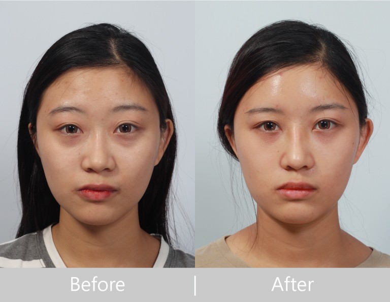 結構式隆鼻手術打造精緻鼻曲線-極緻醫美診所