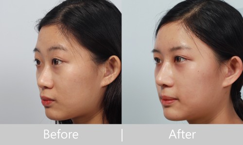 素人隆鼻手術案例方享-極緻醫美診所