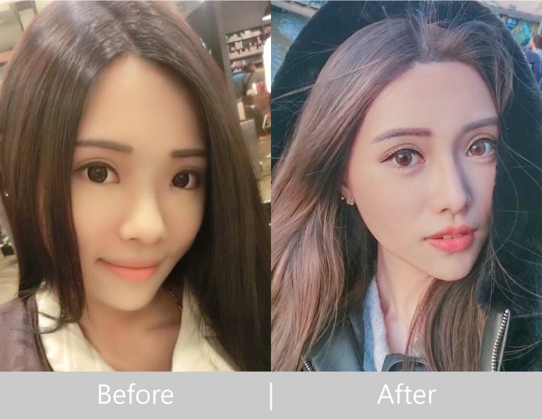 縮鼻頭隆鼻案例分享-極緻醫美診所