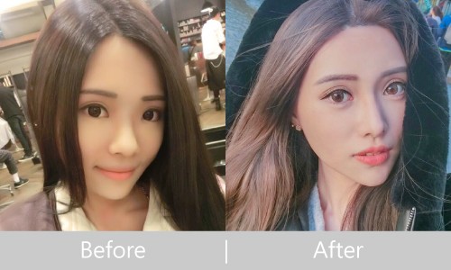 縮鼻頭隆鼻案例分享-極緻醫美診所