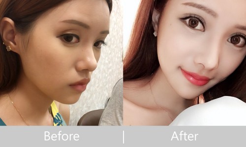 山根調整隆鼻案例分享-極緻醫美診所