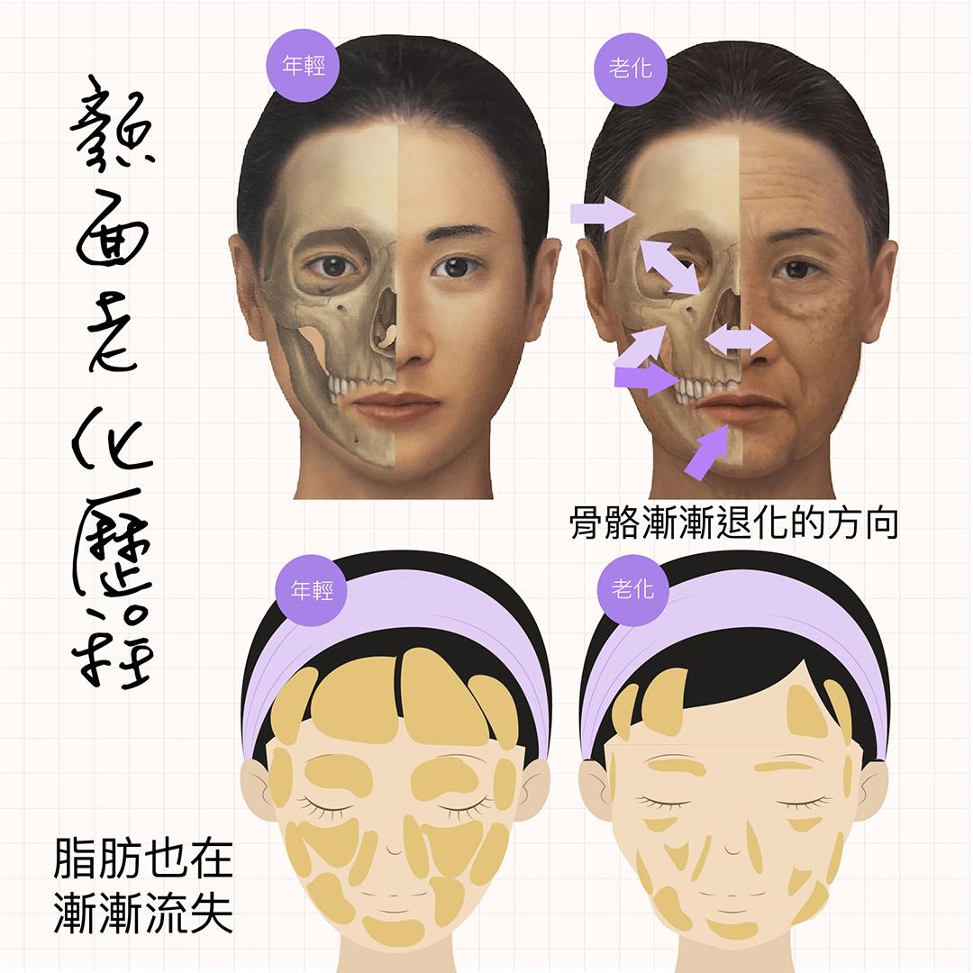 顏面骨質疏鬆也是老化元兇之一？