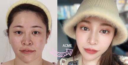 複合式眼整形｜無神又單的多層眼皮～改善全紀錄