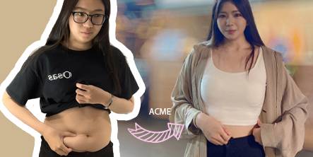 腹部抽脂｜小蠻腰出現了!!終於駕馭自己喜歡的衣服(多圖分享)