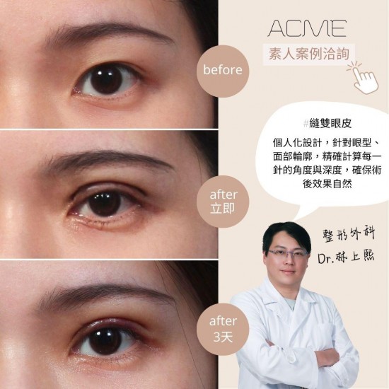 雙眼皮貼 vs. 縫雙眼皮，該選哪一種？