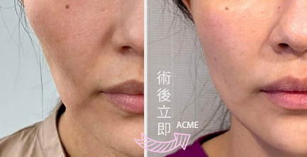 太強了鳳凰電波｜不是掃過一遍就是打過鳳凰～資深醫師來解惑