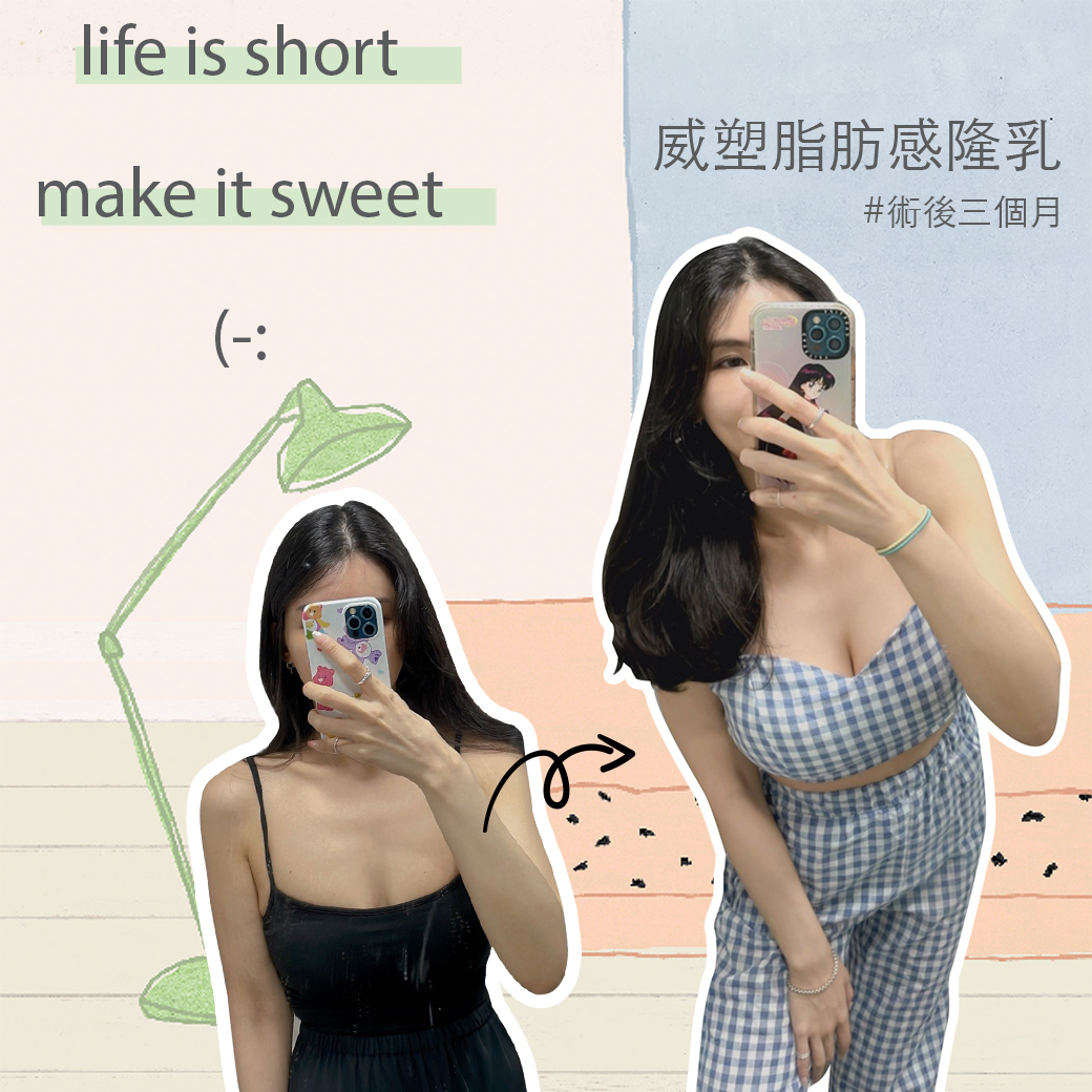 複合式脂肪感隆乳新趨勢？