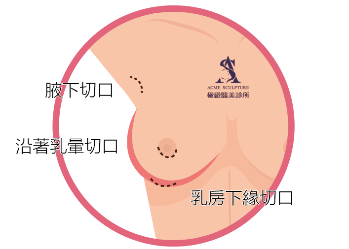 張峯瑞醫師｜隆乳切口介紹＜隱痕花瓣式隆乳＞